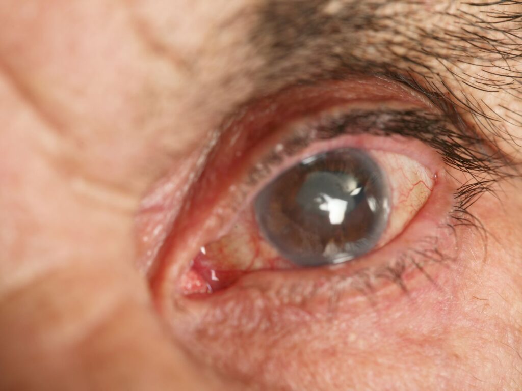 an up close picture of an irritated eye